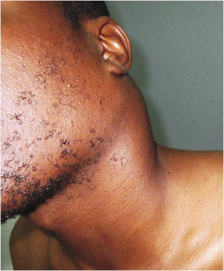 This clinical photograph displays a lateral view of a young adult male with severe cervical lymphadenopathy. A massive, prominent swelling is visible in the left posterior and lateral cervical region, measuring approximately 10 cm in diameter. The mass causes significant distortion of the normal neck contour, with the overlying skin appearing taut and stretched due to underlying pressure. The swelling extends from the submandibular area toward the supraclavicular region. No overt skin discoloration, ulceration, or inflammatory erythema is noted over the mass, though there is a subtle prominence of superficial vasculature. The patient’s facial hair is sparse and curly, with visible follicular patterns. In the clinical context of progressive lymphadenopathy resistant to antibiotics and anti-tuberculous therapy, this presentation is characteristic of hematologic malignancy, specifically diffuse large B-cell lymphoma (DLBCL). The image serves as an educational example of dramatic nodal enlargement and the importance of biopsy in cases of persistent lymphadenopathy.