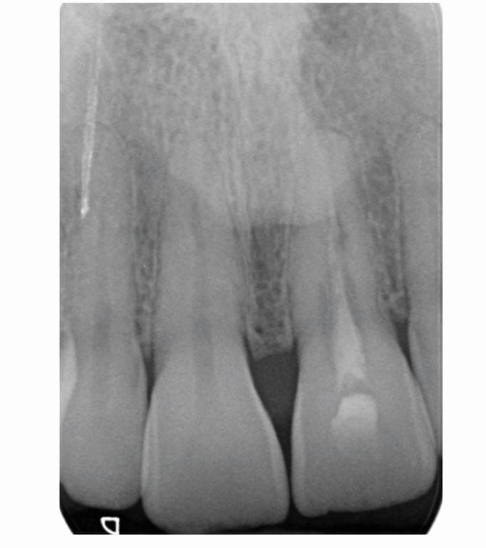 An intra-operative periapical radiograph of the anterior maxilla, specifically focusing on the left central incisor (tooth 21). The image demonstrates a diagnostic image modality used in endodontics to monitor treatment progress. The root canal system of tooth 21 exhibits an irregular, tunneling appearance characterized by variable radiolucency throughout its course. This morphology is indicative of internal tunneling resorption (ITR), where resorptive channels burrow into the radicular tissue. A radio-opaque intracanal medicament, calcium hydroxide, is visible within the confines of the root canal system, appearing as a denser, more uniform material compared to the surrounding tunneling defects. The apical region of tooth 21 shows blunting and irregularity relative to the more tapered apices of adjacent teeth. The periapical bone appears healthy with an intact periodontal ligament space and lamina dura, indicating no active periapical pathosis at this stage. This visual is significant for illustrating the complex canal anatomy resulting from resorptive processes and the clinical application of inter-appointment medicaments in conservative endodontic therapy.