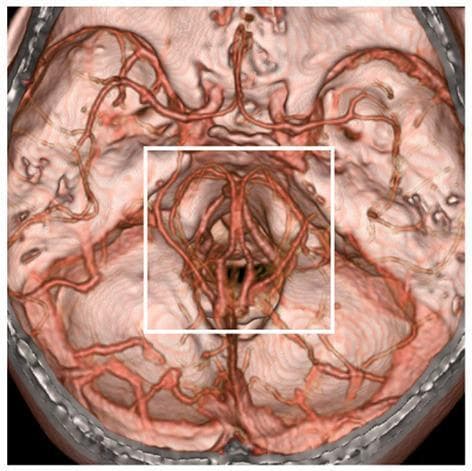 This diagnostic image is a 3D volume-rendered computed tomography angiography (CTA) showing the cerebral vasculature at the skull base from an inferior view. The rendering uses a reddish-brown color scheme to delineate the arteries and deep veins relative to the brain tissue and cranial floor. A white square box highlights the perimesencephalic region, specifically focusing on the vessels surrounding the midbrain and the Circle of Willis. This region is clinically significant as the primary site for investigating the etiology of perimesencephalic non-aneurysmal subarachnoid hemorrhage (PNSAH). The image demonstrates complex vascular anatomy, including the basilar artery, posterior cerebral arteries, and the potential involvement of deep venous structures such as the basal vein of Rosenthal. By extending CTA acquisition time, this visualization captures both the arterial and deep venous systems simultaneously, which is essential for excluding aneurysms or identifying venous ruptures as the cause of hemorrhage in this anatomical location.