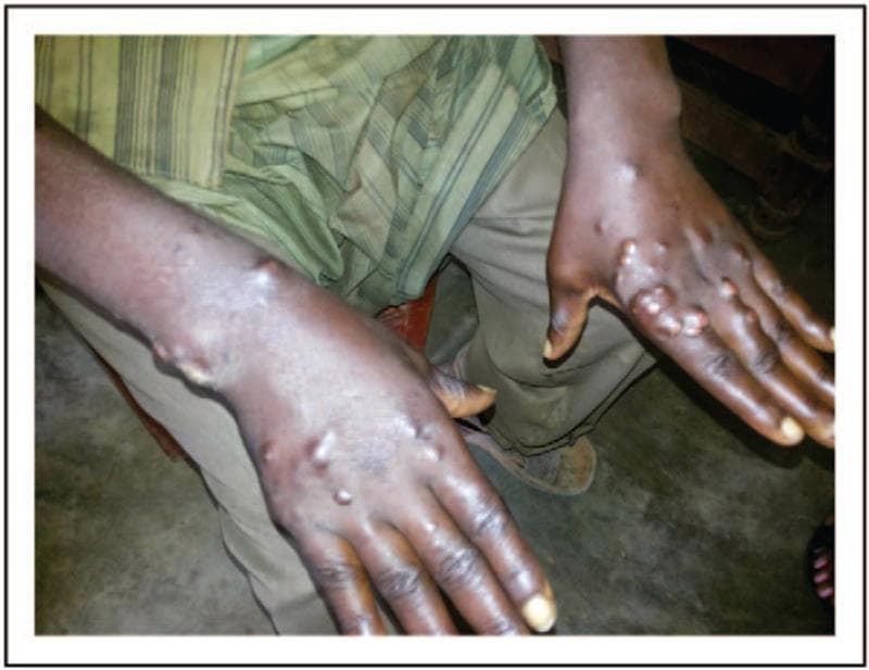 This clinical photograph displays the bilateral hands and distal forearms of a patient with lepromatous leprosy, showcasing characteristic dermatological manifestations. The image reveals numerous disseminated, firm, skin-colored to slightly hyperpigmented nodules and papules. These lesions are most prominent on the dorsal surfaces of the hands, particularly overlying the metacarpophalangeal joints and along the extensor aspects of the forearms. The nodules vary in size, with some coalescing into larger, dome-shaped masses. The surrounding skin appears thickened and exhibits a subtle waxy or shiny texture, consistent with diffuse infiltration or localized edema common in the lepromatous spectrum of the disease. The symmetric distribution and nodular morphology are hallmark features of a high bacillary load and a Th2-mediated immune response. This visual provides a classic example of multibacillary leprosy for clinical education in infectious diseases and dermatology, emphasizing the importance of recognizing nodular cutaneous presentations in endemic regions.