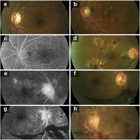 A multi-panel ophthalmological image set displaying eight photographs (a-h) that illustrate the progression of Diabetic Retinopathy (DR). The set includes color fundus photographs and Fluorescein Angiography (FA) images. (a) Moderate Non-Proliferative Diabetic Retinopathy (NPDR) with scattered microaneurysms. (b) Severe NPDR showing intraretinal hemorrhages and hard exudates. (c) Corresponding FA for severe NPDR highlighting hyperfluorescent microaneurysms. (d) Early Proliferative Diabetic Retinopathy (PDR) with prominent circinate exudates and cotton-wool spots. (e) FA of early PDR demonstrating focal leakage and early neovascularization at the disc (NVD). (f) High-risk PDR with visible vitreous haze and vascular tortuosity. (g) FA for high-risk PDR showing extensive leakage from neovascularization and areas of capillary non-perfusion (ischemia). (h) Advanced Diabetic Eye Disease (ADED) characterized by fibrovascular proliferation, tractional retinal changes, and significant obscuration of the optic disc and retinal landmarks. This collection serves as a comparative diagnostic tool for identifying vascular leakage, retinal ischemia, and proliferative changes across different clinical stages of diabetic eye disease.