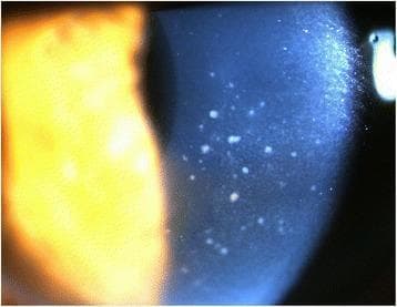 This clinical photograph, taken via slit lamp microscopy, displays the anterior segment of a human eye with a focus on corneal pathology. The image reveals diffuse keratic precipitates (KPs) distributed primarily across the central area of the corneal endothelium. These precipitates are characterized by a 'mutton-fat' appearance, manifesting as whitish, waxy, and irregularly shaped inflammatory deposits. Such findings are indicative of granulomatous uveitis, often associated with conditions like Cytomegalovirus (CMV) hypertensive anterior uveitis or sarcoidosis. The slit lamp beam highlights the depth of these deposits on the posterior corneal surface. Additionally, a mild inflammatory reaction is noted within the anterior chamber, though cell and flare are not individually resolvable at this magnification. This visual evidence serves as a critical diagnostic marker for differentiating types of intraocular inflammation and monitoring treatment response in patients with secondary glaucoma or viral uveitis.