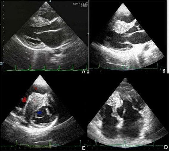 This set of four transthoracic echocardiogram (TTE) images illustrates different phenotypic manifestations of Hypertrophic Cardiomyopathy (HCM). Panel A shows a Parasternal Long Axis (PLAX) view demonstrating asymmetric septal hypertrophy (ASH), where the interventricular septum (IVS) is significantly thicker than the posterior wall (ratio > 1.3). Panel B displays massive septal hypertrophy with a diastolic thickness exceeding 30 mm. Panel C utilizes color Doppler to show the clinical consequences of massive hypertrophy, specifically demonstrating Right Ventricular Outflow Tract (RVOT) obstruction caused by the septal bulge into the right ventricle. Panel D illustrates Mid-Ventricular Obstructive Hypertrophic Cardiomyopathy (MOHC), characterized by an 'hourglass' shaped left ventricle. This morphology creates two distinct chambers: a dilated proximal chamber with a bulging basal septum and a distal chamber, which in this case represents an apical aneurysm. These diagnostic images are essential for identifying risk factors for sudden cardiac death and planning surgical or medical management in cardiology.