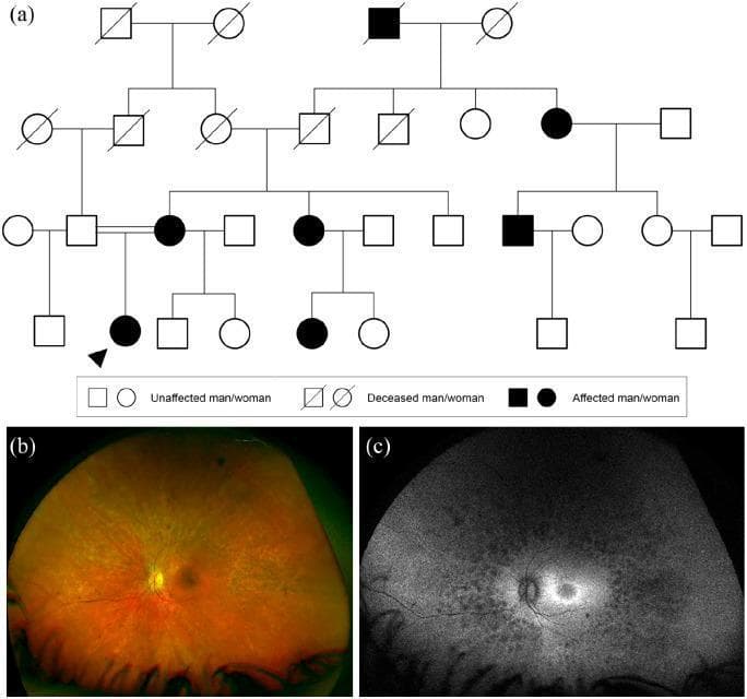 Educational panel illustrating the clinical and genetic characteristics of autosomal dominant retinitis pigmentosa (RP) with reduced penetrance.
(a) A four-generation pedigree diagram demonstrating an autosomal dominant inheritance pattern. Affected individuals (filled symbols) are present in multiple generations, though the presence of an unaffected carrier mother of the proband highlights reduced penetrance.
(b) Widefield color fundus photograph of a right eye showing classic RP features: significant retinal arteriolar attenuation and scattered, dark, bone spicule-like pigmentary deposits in the mid-periphery. The optic disc appears slightly pale, consistent with waxy disc pallor.
(c) Widefield fundus autofluorescence (FAF) image of the same eye. It displays a characteristic perifoveal hyperautofluorescent ring, indicating metabolic stress and lipofuscin accumulation in the RPE at the border of progressing degeneration. Outside the vascular arcades, there are extensive mottled areas of hypoautofluorescence corresponding to RPE atrophy and loss of photoreceptor integrity.
This composite serves as a diagnostic reference for hereditary retinal dystrophies, specifically highlighting the clinical manifestation of PRPF31-related retinitis pigmentosa.