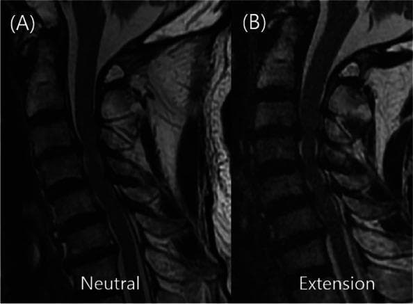 This diagnostic image consists of side-by-side sagittal T2-weighted magnetic resonance imaging (MRI) scans of the cervical spine, demonstrating dynamic changes in spinal cord compression. Image A shows the spine in a neutral position, where focal spinal cord compression (Cervical Spondylotic Myelopathy) is primarily visible at the C3–C4 level. Image B shows the same patient in an extension posture, which reveals significant multi-level dynamic compression extending from C3 through C7. Key visual features include the buckling of the ligamentum flavum posteriorly and disc-osteophyte complexes anteriorly that narrow the spinal canal more severely during extension than in the neutral state. The image serves as an educational tool for dynamic cervical MRI (dMRI), illustrating how neutral imaging can underestimate the extent of myelopathy and how extension maneuvers can identify additional levels of pathological cord impingement, critical for surgical planning in Cervical Spondylotic Myelopathy (CSM).