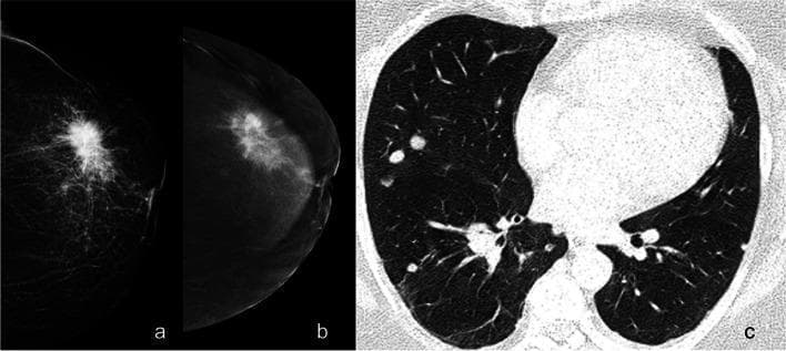 This composite diagnostic image illustrates breast cancer staging using various imaging modalities. Panel (a) is a mammogram showing a large, high-density, irregularly shaped mass in the left breast characterized by prominent radiating spicules, a classic sign of malignancy. Panel (b) shows contrast-enhanced mammography (CEM), which reveals intense enhancement of the primary lesion and provides clearer visualization of disease extent, including involvement of the retroareolar ducts. Panel (c) is a thoracic axial contrast-enhanced CT (CE-CT) scan in a lung window, demonstrating multiple bilateral, well-circumscribed pulmonary nodules. These findings collectively illustrate primary breast adenocarcinoma with secondary lung metastases. The educational focus is on the multi-modal assessment of cancer, demonstrating how unenhanced imaging (a), contrast-enhanced breast imaging (b), and systemic staging scans (c) contribute to defining the clinical stage and disease burden in oncology patients.