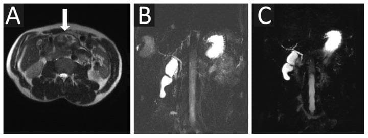 This composite of magnetic resonance imaging (MRI) scans highlights diagnostic findings in a 35-year-old male with a pancreatic pseudocyst. Image A is an axial T2-weighted abdominal scan showing a pancreatic pseudocyst (indicated by a white arrow) characterized by an atypical low or mixed-low signal intensity, located in the peripancreatic region. Images B and C present Magnetic Resonance Cholangiopancreatography (MRCP) views in 2D and 3D formats, respectively. Both MRCP modalities demonstrate high-signal (bright) intensity within the biliary tree, including the gallbladder, cystic duct, and common bile duct. The 3D MRCP in panel C offers superior spatial resolution and anatomical detail compared to the 2D reconstruction in panel B. Notably, neither MRCP sequence successfully visualizes the cystic lesion or its communication with the main pancreatic duct, illustrating potential limitations of standard MRCP in detecting certain pseudocysts that present with low T2 signal intensity. These images are essential for understanding the comparative utility of different MRI sequences in hepatobiliary and pancreatic pathology.
