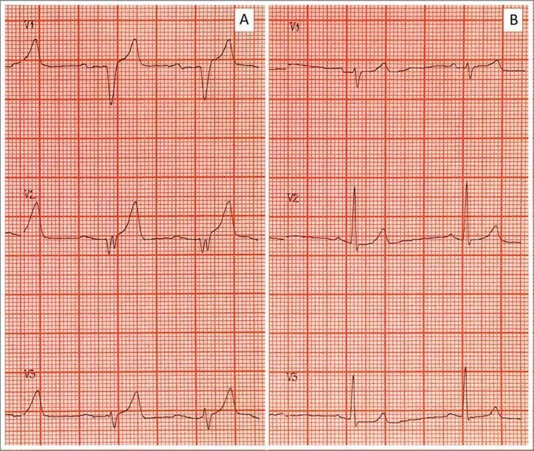 Side-by-side comparison of two electrocardiogram (ECG) tracings (A and B) demonstrating the classic cardiotoxic evolution and subsequent resolution of severe hyperkalemia. Panel A (Pretreatment) displays several pathognomonic findings including prominent, tall, tented, or 'peaked' T-waves; significant flattening and widening of the P-waves; a prolonged PR interval; and a widened QRS complex with a 'sine-wave' appearance in certain leads. These features reflect impaired atrial and ventricular conduction and delayed repolarization associated with elevated serum potassium (e.g., 9.25 mEq/L). Panel B (Post-treatment) shows the results of medical intervention (such as calcium gluconate, insulin/glucose, and bicarbonate), characterized by the normalization of the ECG morphology. Key changes in Panel B include the return of distinct P-waves, narrowing of the QRS complex to normal duration, and a reduction in T-wave amplitude to a typical physiological morphology. The images are shown on standard ECG grid paper, facilitating the assessment of interval and complex durations.