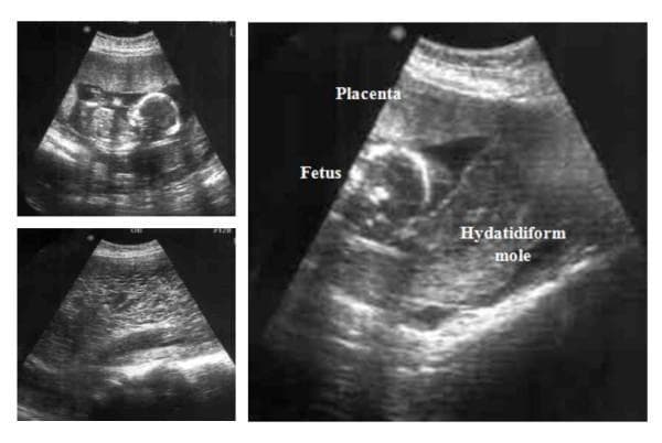 This obstetric ultrasound composite displays a rare twin pregnancy consisting of a complete hydatidiform mole and a coexisting live fetus. In the primary longitudinal view, the uterus contains two distinct compartments. One compartment shows a normal fetus with discernible anatomical landmarks and an adjacent granular, well-defined placenta. The secondary compartment is occupied by a large, heterogeneous, echogenic mass characteristic of a complete hydatidiform mole, often described as having a 'snowstorm' appearance due to complex internal cystic spaces and hydropic villi. The molar tissue is predominantly localized in the lower uterine pole. The separate smaller ultrasound frames highlight these findings individually: one focusing on the fetal anatomy and the other on the diffuse, amorphous texture of the gestational trophoblastic disease. This visual illustrates a high-risk obstetric scenario requiring careful monitoring for complications like pre-eclampsia and thyrotoxicosis due to extremely elevated beta-hCG levels.