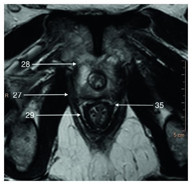 This T2-weighted axial magnetic resonance imaging (MRI) scan displays the cross-sectional anatomy of the male pelvic floor at the level of the prostate apex. The image highlights the musculoskeletal and fascial relationships critical for pelvic surgery. The central feature is the prostate gland, which exhibits a hyperintense (bright) signal relative to the surrounding pelvic musculature. Key anatomical landmarks are labeled: 28 indicates the puboprostatic (levator prostate) muscle located anterior to the gland; 27 denotes the pubococcygeus muscle situated laterally; 29 marks the puborectalis muscle located inferiorly, forming part of the levator ani complex; and 35 identifies the pararectal fascia positioned posteriorly, separating the rectum from the levator ani. The pelvic muscles generally appear hypointense (dark), providing high contrast against the glandular tissue and periprostatic fat. This diagnostic imaging serves as an educational tool for understanding the zonal anatomy of the prostate and the complex fascial planes of the lesser pelvis.