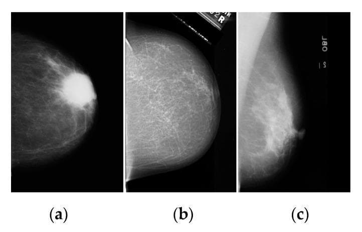 This diagnostic image presents a side-by-side comparison of three x-ray mammograms (labeled a, b, and c) sourced from different clinical datasets (BCDR, DDSM, and Mini–MIAS). Image (a) demonstrates a highly conspicuous, radiodense, and well-defined oval mass in the central breast tissue, contrasting sharply against the surrounding darker, fatty parenchyma—a key indicator for breast cancer screening. Image (b) shows a more heterogeneous and granular tissue texture with prominent fibroglandular patterns but no discrete, solitary mass; a textual marker/artifact is visible at the top edge. Image (c) displays moderate contrast with a stringy, fibrous tissue texture and a visible nipple region on the right margin, alongside vertical textual annotations. The collection serves to illustrate the visual variability of breast tissue density, the appearance of suspicious lesions, and the presence of common imaging artifacts in mammography. This material is primarily used for training computer-aided diagnosis (CAD) systems in lesion segmentation and edge detection using algorithms such as K-means, FCM, and Sobel operators.