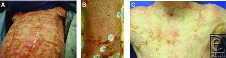 A series of three clinical photographs (A, B, and C) illustrating the progression of burn wound healing and surgical intervention on the anterior trunk. Image A shows acute deep-partial to full-thickness burns with significant inflammation, mottled red and pink tissue, and horizontal escharotomy incisions across the thorax and abdomen to improve compliance. Small white wound dressings or surgical clips are visible along the incision lines. Image B depicts an intermediate stage of healing where a large-area meshed skin graft has been applied to the trunk, showing a characteristic geometric pattern over the underlying wound bed; circular ECG monitoring electrodes are adhered to the right side. Image C shows the later stages of healing and re-epithelialization on the upper chest. The skin appears lighter and more uniform but exhibits residual erythematous scarring, texture irregularities, and hypertrophic changes. A tracheostomy site is visible at the midline of the neck, and the overall integrity of the skin barrier shows significant improvement from the initial presentation.