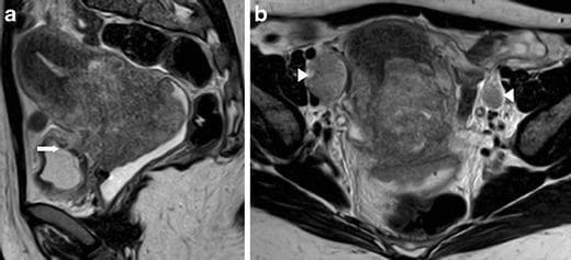 This diagnostic imaging panel consists of two T2-weighted MRI scans of the female pelvis (sagittal and axial views) demonstrating an advanced-stage cervical neuroendocrine tumor (FIGO Stage IV-A). Image (a), a sagittal T2-weighted MR image, reveals a large, heterogeneous, high-signal cervical mass infiltrating the lower uterine segment. Significant anterior extension is visible with transmural invasion into the urinary bladder and the formation of a fistula (marked by white arrow). Image (b), an axial T2-weighted MR image, shows the primary tumor circumferentially infiltrating the bilateral parametria. Associated metastatic disease is evidenced by enlarged, rounded lymph nodes in the external iliac groups bilaterally (indicated by white arrowheads). These images illustrate the aggressive local invasion and regional lymphatic spread characteristic of high-grade neuroendocrine cervical malignancies. This material is suitable for medical education regarding oncologic imaging, staging of cervical cancer, and identifying complex pelvic organ invasion on MRI.