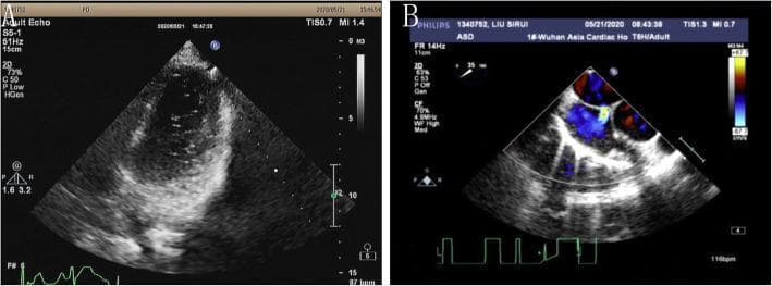 This composite diagnostic image displays echocardiographic findings of an atrial septal defect (ASD) in a 16-year-old patient. Panel A shows a transthoracic echocardiogram (TTE) in a grayscale 2D view. It illustrates the right heart morphology where varied echogenicity within the atrial chambers suggests right-to-left shunting. Panel B presents a transesophageal echocardiogram (TEE) utilizing color Doppler mapping. This panel clearly demonstrates a bidirectional shunt across the atrial septum. A physical interruption in the septal wall is visible, accompanied by a high-velocity color signal. The color Doppler displays a shift from blue to red, indicating the flow direction from the left atrium to the right atrium (left-to-right shunt) at the site of the ASD. The images are essential for delineating ASD morphology, measuring the defect size (approximately 0.6 cm in this case), and assessing the surrounding septal rims before transcatheter closure interventions. These views are typical in cardiology for diagnosing congenital heart defects and planning septal occluder placement.