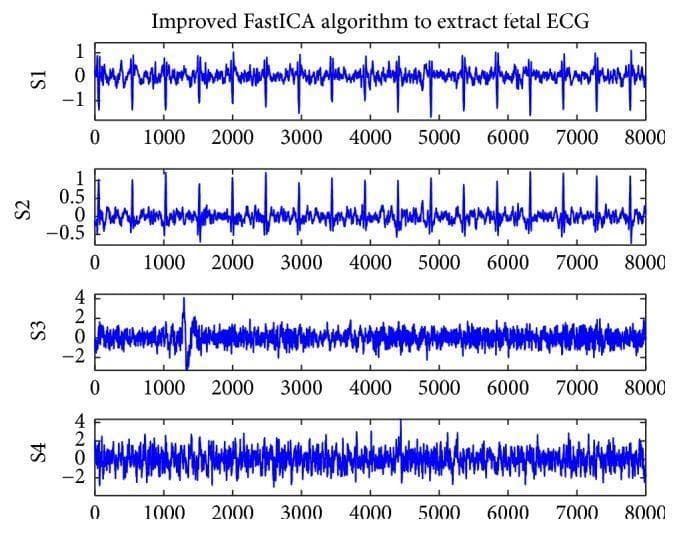 This diagnostic visualization displays four stacked signal tracings (S1, S2, S3, and S4) representing the extraction of fetal electrocardiogram (fECG) signals using an improved FastICA algorithm. The signals are plotted against a time-domain horizontal axis (0 to 8000 samples). S1 and S2 demonstrate periodic waveforms characteristic of ECG complexes, featuring distinct and recurring sharp upward deflections that correspond to R-waves. S1 shows higher amplitude and clearer R-wave morphology compared to S2, indicating a cleaner extraction of the fetal heart rate signal from maternal abdominal interference. In contrast, S3 and S4 exhibit irregular, high-frequency fluctuations and lack discernible periodic patterns, representing residual noise and non-cardiac signal components. This comparison is used in medical engineering and cardiology to demonstrate the efficacy of blind source separation algorithms in isolating fetal cardiac activity from mixed maternal abdominal recordings, which is critical for non-invasive fetal monitoring.