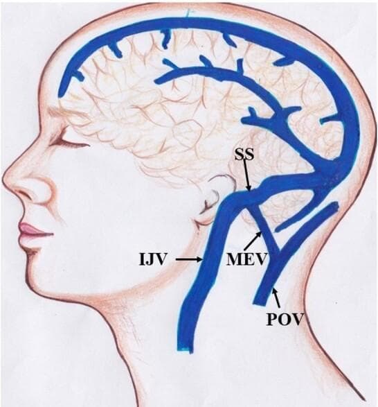 Anatomical diagram depicting the venous drainage of the human head in a lateral view. The illustration highlights the relationship between intracranial dural sinuses and extracranial veins. Key structures identified include the Sigmoid Sinus (SS), which transitions into the Internal Jugular Vein (IJV) as it descends anteriorly. A significant anatomical feature shown is the Mastoid Emissary Vein (MEV), which provides a valveless communication pathway between the intracranial sigmoid sinus and the extracranial Posterior Auricular Vein (POV). The POV is situated posteriorly to the ear and runs roughly parallel to the upper portion of the IJV. The diagram effectively illustrates the concept of emissary veins as collateral drainage routes and their role in intracranial pressure regulation and potential surgical risk during posterior fossa or mastoid procedures. The focus is on neurovascular anatomy, specifically the communication between the dural venous system and superficial scalp veins.