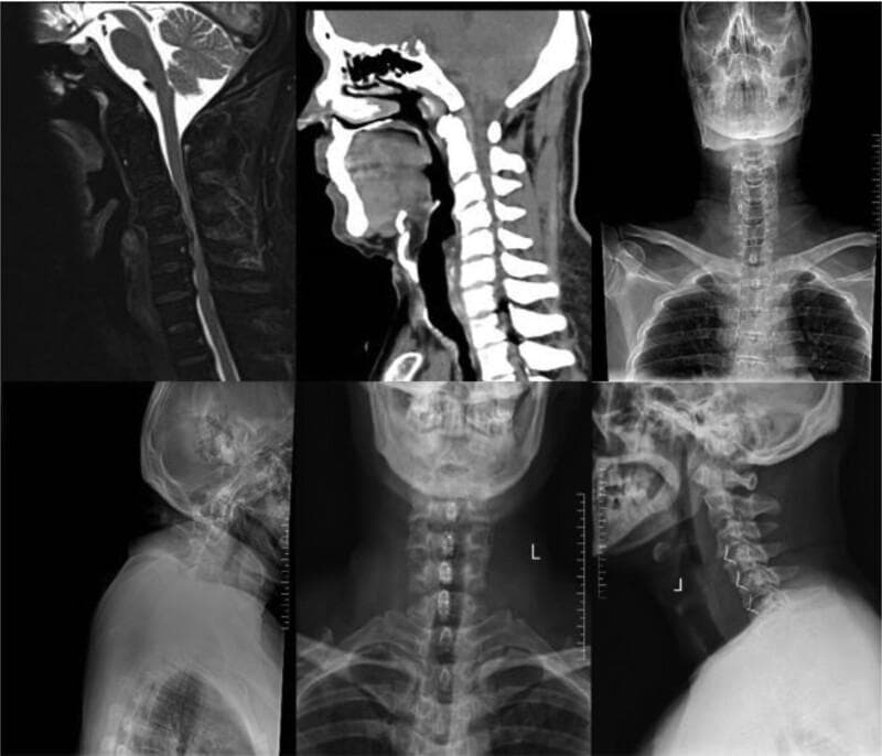 A multi-modal radiographic composite illustrating the cervical spine and surgical outcomes for cervical spondylosis. The upper panels display a sagittal T2-weighted MRI, a sagittal CT scan, and an anteroposterior (AP) X-ray of the head, neck, and upper thorax. The MRI highlights soft tissue structures, specifically showing cerebrospinal fluid (bright white) and the spinal cord. The CT emphasizes bony morphology and vertebral alignment. The lower panels provide follow-up radiographs, including AP and lateral X-rays, demonstrating post-surgical status. These images reveal multi-level internal fixation, specifically ROI-C interbody spacers placed within the intervertebral disc spaces of the middle to lower cervical spine. On the lateral view, the radiopaque fixators are visible across four segments, restoring disc space height and maintaining cervical lordosis (Cobb angle). This educational material demonstrates the combined use of diagnostic imaging (MRI/CT) and postoperative monitoring (radiography) in managing multi-segment spinal cord compression and evaluating the stability of anterior cervical discectomy and fusion (ACDF) instrumentation.