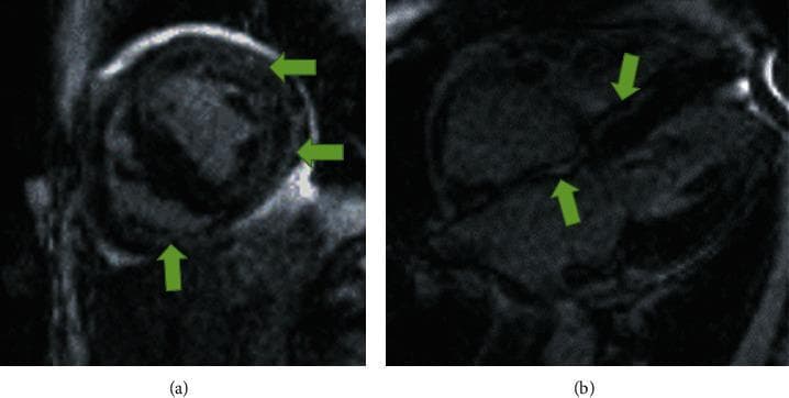 This diagnostic imaging figure consists of two delayed gadolinium enhancement (LGE) cardiac MRI sequences demonstrating hallmark findings of infiltrative cardiomyopathy, specifically cardiac amyloidosis. Image (a) displays a short-axis view of the ventricles, where green arrows indicate extensive, diffuse mid-myocardial and subendocardial late gadolinium enhancement within the left ventricular myocardium. Image (b) presents a four-chamber view highlighting significant enhancement along the atrial walls and the interatrial septum (green arrows), which is a highly suggestive feature of amyloid deposition. The enhancement patterns do not follow a specific coronary vascular territory, distinguishing this from ischemic injury. Anatomically, the images show thickened myocardial walls and biatrial enlargement, consistent with the restrictive filling patterns and decreased systolic function associated with wild-type transthyretin amyloidosis (wt-ATTR). These visual markers serve as critical diagnostic evidence for differentiating amyloidosis from other forms of hypertrophic or restrictive heart disease in clinical cardiology.