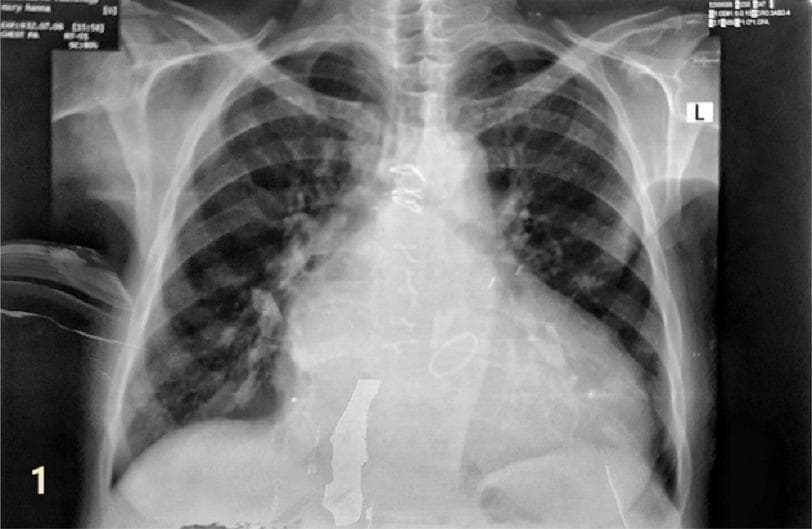 This diagnostic image is a posterior-anterior (PA) chest X-ray demonstrating significant cardiothoracic pathology. The primary finding is marked cardiomegaly with a widened cardiac silhouette. Specific chamber enlargement is visible, including a prominent left atrial contour along the mid-left heart border and signs of biventricular enlargement. In the pulmonary fields, there is evidence of pulmonary venous congestion and interstitial edema, characterized by cephalization of the pulmonary vessels (prominence of upper lobe vessels) and increased hazy opacities throughout both lung fields. Sternal wires and a mitral valve prosthesis are visible, indicating prior cardiac surgery. This image is an educational example of advanced heart failure and valvular heart disease manifestations on radiography, illustrating the relationship between cardiac structural changes and secondary pulmonary vascular congestion.