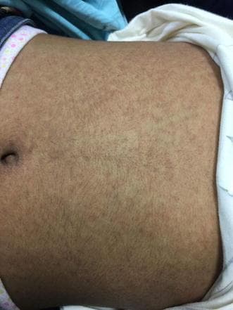 This clinical photograph displays an erythematous maculopapular rash on the abdomen of a patient. The eruption is characterized by a diffuse and symmetric distribution of numerous small, reddish, non-confluent lesions. Individual lesions are primarily macules and slight papules, mostly round to oval in shape and under 5mm in diameter. The rash covers a broad anatomical region, extending across the umbilical and epigastric areas without following a dermatomal or specific linear pattern. The background skin appears tanned, providing a visual contrast to the inflammatory erythematous spots. This morphology is common in systemic conditions such as viral exanthems, drug eruptions, or certain bacterial infections. The visual information serves as a classic educational example of a generalized maculopapular eruption, useful for clinical dermatology and infectious disease studies.