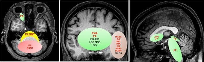 This composite educational illustration demonstrates the spatial clustering and preferred neuroanatomical locations of Pediatric Low-Grade Neuroepithelial Tumor (PLGNT) phenotypes. Three T1-weighted MRI planes (axial, coronal, and sagittal) are used as templates with overlaid color-coded regions and tumor abbreviations. Red/pink zones indicate cerebellar clustering, including Pilocytic Astrocytoma (PA) and Rosette-forming Glioneuronal Tumor (RGNT). Green zones represent midline structures: PA is shown in the optic pathway (axial) and brainstem (sagittal); Pilomyxoid Astrocytoma (PMA) and others are localized to the hypothalamic/chiasmatic region (coronal); and Tectal Glioma (TG) is at the midbrain. Brown/tan zones signify hemispheric locations, encompassing cortical and deep brain tumors such as Ganglioglioma (GG), Dysembryoplastic Neuroepithelial Tumor (DNT), Pleomorphic Xanthoastrocytoma (PXA), and Angiocentric Glioma (AG). A yellow zone in the axial view highlights the Diffuse Leptomeningeal Glioneuronal Tumor (DLGNT) along the midline leptomeningeal surfaces. The diagram serves as a diagnostic guide for neuroradiology, emphasizing that specific histological phenotypes are spatially enriched based on their underlying molecular drivers.
