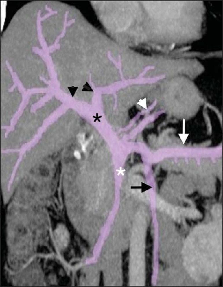 This reformatted coronal CT scan highlights the vascular anatomy of the human portal venous system, with vessels enhanced in purple for educational clarity. The image demonstrates the formation of the main portal vein (black asterisk) at the confluence of the superior mesenteric vein (white asterisk) and the splenic vein (white arrow). The splenic vein is shown receiving drainage from the gastroepiploic vein and pancreatic branches (white arrowhead). The inferior mesenteric vein (black arrow) is visible draining into the splenic vein. Distally, the main portal vein enters the liver hilum and bifurcates into its primary right and left intrahepatic portal branches (black arrowheads). This diagnostic image is essential for understanding the hepatoportal circulation, identifying the origins of portal hypertension, and mapping pre-surgical anatomy for liver or pancreatic interventions. The visualization clearly depicts the relationship between mesenteric drainage and the hepatic inflow tract.