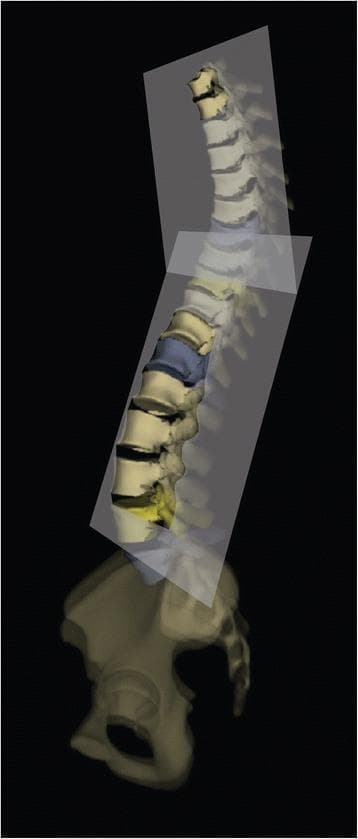An anatomical diagram and pathophysiology illustration demonstrating a 3D reconstruction of a human vertebral column and pelvis from a lateral-oblique perspective. The diagram illustrates the 'Best Fit Plane' (BFP) concept used in the assessment of spinal deformities such as Adolescent Idiopathic Scoliosis (AIS). Two semi-transparent geometric planes are shown intersecting the spine: one aligned with the thoracic region and another with the lumbar region. These planes represent the mathematical calculation that minimizes the distances between the centroids of each vertebral body within specified spinal segments. The vertebral column exhibits physiological curvatures, with specific vertebrae highlighted in blue and yellow to denote apex or end vertebrae within the curvature segments. This visual model is essential for clinical biomechanics and orthopedic surgery planning, as it provides a three-dimensional understanding of spinal rotation and deviation beyond two-dimensional radiographic projections.