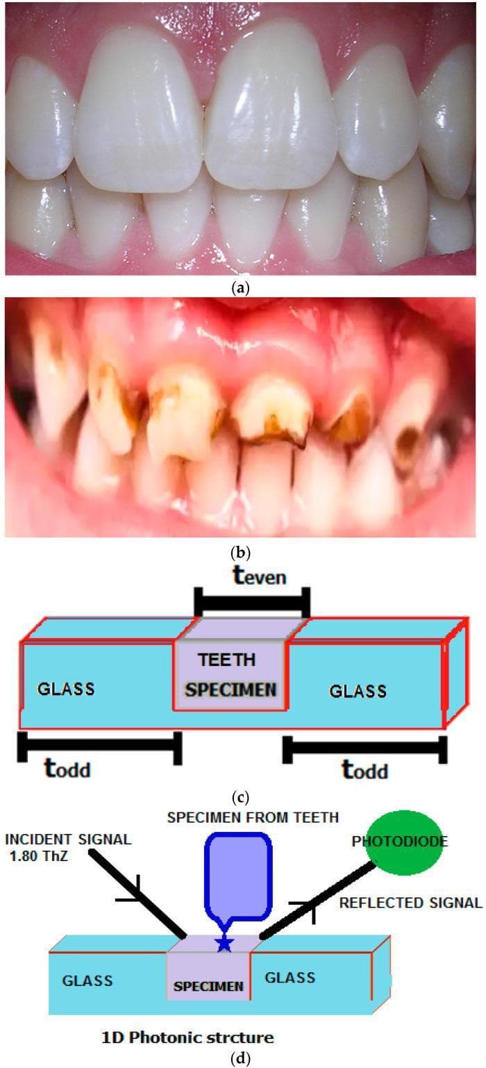 This composite educational graphic illustrates clinical and experimental aspects of dental caries. (a) A clinical photograph displays healthy permanent dentition with intact enamel, smooth white surfaces, and healthy gingival tissue. (b) A comparative clinical photograph shows abnormal teeth characterized by extensive dental caries; visible signs include significant dark brown discoloration, enamel cavitation, and irregular surface morphology across multiple anterior teeth, accompanied by gingival inflammation. (c) A schematic diagram represents a one-dimensional (1D) photonic crystal structure used for diagnostic analysis, consisting of a sandwich arrangement: two outer glass layers and a central 3 μm tooth specimen layer (enamel or dentine). (d) An experimental algorithm flowchart depicts the measurement process using an incident 1.80 THz signal. The signal interacts with the multilayered photonic structure, and the resulting reflected signal is captured by a photodiode. This setup is designed to evaluate the refractive index and reflectance of dental tissues, correlating physical optical properties with the presence and severity of tooth decay.