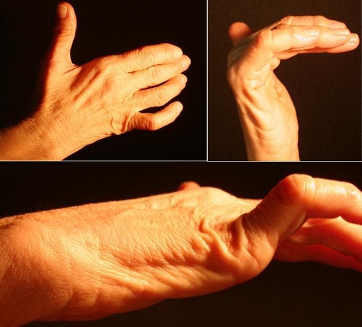 This composite of clinical photographs demonstrates a 'claw hand' (main en griffe) deformity, a characteristic sign of ulnar nerve neuropathy. The images show a right hand from dorsal, palmar, and lateral perspectives. Key visual features include hyperextension at the metacarpophalangeal (MCP) joints and flexion at the proximal and distal interphalangeal (IP) joints, most pronounced in the fourth and fifth digits. There is noticeable atrophy of the hypothenar eminence and hollowing of the interosseous spaces on the dorsal surface, indicating wasting of the intrinsic hand muscles (interossei and ulnar-innervated lumbricals). The thenar eminence appears relatively preserved, though subtle flattening of the adductor pollicis region may be present. This presentation is consistent with distal ulnar nerve compression, such as within Guyon’s canal, leading to motor deficit and muscle denervation. These clinical signs are essential for diagnosing peripheral nerve entrapment syndromes and distinguishing them from proximal lesions or central nervous system pathologies.