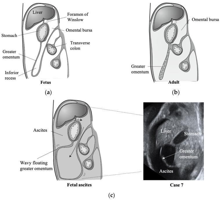 This educational resource features three sagittal schematic diagrams and one corresponding ultrasound image illustrating the embryological development and clinical presentation of the greater omentum and omental bursa. Diagram (a) shows the fetal configuration, where the greater omentum consists of a four-layered peritoneal fold with an open inferior recess extending deeply into the abdominal cavity, posterior to the stomach and anterior to the transverse colon. Diagram (b) demonstrates the adult configuration, where the anterior and posterior layers have fused (indicated by dashed lines), obliterating the inferior recess and limiting the vertical extent of the omental bursa. Diagram (c) and the accompanying grayscale ultrasound image (Case 7) depict fetal ascites. In the presence of free intraperitoneal fluid, ascites enters the omental bursa through the foramen of Winslow. This fluid separates the peritoneal layers, causing the greater omentum to appear as a 'wavy floating' structure within the fluid collection. Key labeled landmarks include the liver, stomach, transverse colon, and foramen of Winslow, highlighting the spatial relationship between the lesser sac and the greater peritoneal cavity.
