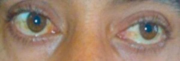 This clinical photograph shows a close-up view of a patient's eyes demonstrating bilateral asymmetric ptosis (drooping of the upper eyelids). The right upper eyelid (left side of the image) exhibits a more severe degree of ptosis compared to the left, resulting in a narrower palpebral fissure and significant coverage of the superior iris. Conversely, the left upper eyelid margin is positioned higher, revealing more of the ocular surface. The image captures the clinical response during a neostigmine test, a diagnostic investigation used in the evaluation of Myasthenia Gravis to assess for the temporary reversal of muscle weakness. Mild conjunctival injection is visible, particularly in the nasal region of the right eye. This visual is significant for medical education regarding the diagnostic workup of neuromuscular junction disorders and the clinical manifestation of ocular myasthenia.
