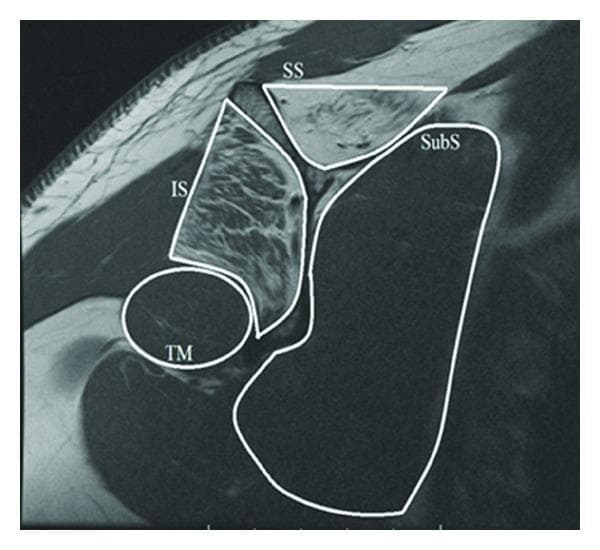 A T1-weighted MRI scan in the sagittal oblique plane demonstrating the rotator cuff musculature of the shoulder. The image highlights the anatomical arrangement and tissue characteristics of the four primary rotator cuff muscles, delineated by white outlines: the supraspinatus (SS), infraspinatus (IS), subscapularis (SubS), and teres minor (TM). Clinically significant findings include increased T1 signal intensity (hyperintensity) within the muscle bellies of the supraspinatus and infraspinatus, indicative of advanced fatty infiltration and muscle atrophy. In contrast, the subscapularis and teres minor maintain a normal, lower signal intensity (isointense to other skeletal muscles). The spatial relationship shows the supraspinatus superiorly, the infraspinatus posteriorly, the subscapularis anteriorly, and the teres minor inferior to the infraspinatus. This diagnostic image is used in orthopedics and radiology to assess chronic rotator cuff tears and associated muscle degeneration, which has implications for surgical prognosis and functional outcomes.