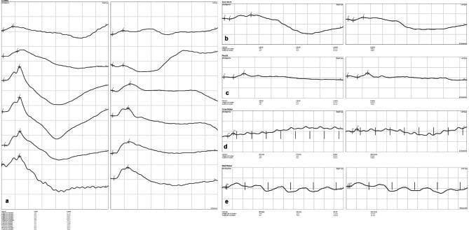 This diagnostic image displays structured electroretinography (ERG) recordings illustrating various retinal responses categorized into five sections (a-e). Section (a) shows the dark adaptation response with multiple serial waveforms demonstrating changes in retinal sensitivity over time under scotopic conditions. Section (b) displays the mixed rod-cone response, characterized by well-defined a-waves (initial negative deflection) and b-waves (positive deflection). Section (c) represents the photopic response, showing single-flash waveforms under light-adapted conditions. Sections (d) and (e) illustrate the cone flicker and rod flicker responses, respectively, featuring rhythmic oscillatory patterns in response to repetitive light stimuli. Key clinical markers are annotated throughout, including flash onset (N), a-wave (a), b-wave (b), and oscillatory potential (P) latencies. The graphs provide a bilateral comparison between left and right eye function, serving as an educational resource for assessing retinal electrophysiology, photoreceptor health, and the diagnostic differentiation of rod and cone system pathologies.