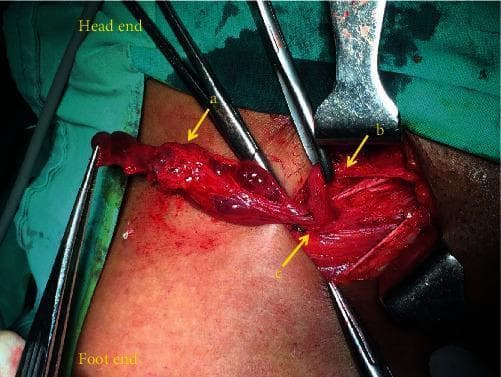 This intraoperative clinical photograph displays an exploration of the right inguinal canal in a female patient. The primary pathology is a multiloculated cystic mass (labeled 'a'), characterized by several interconnected, reddish-brown, semi-translucent sacs with thin walls and an irregular surface. The mass is positioned anterior to the round ligament of the uterus (labeled 'b'), which appears as a distinct fibrous cord-like structure. The deep inguinal ring (labeled 'c') is visible as the anatomical gateway where these structures emerge from the abdominal cavity. Surgical instruments including retractors and forceps are used to expose the operative field. The visual findings are consistent with Nuck's canal endometriosis or a multilocular hydrocele of the canal of Nuck. This image serves as an educational resource for general surgeons and gynecologists regarding the differential diagnosis of inguinal masses in women and the surgical anatomy of the round ligament within the inguinal canal.