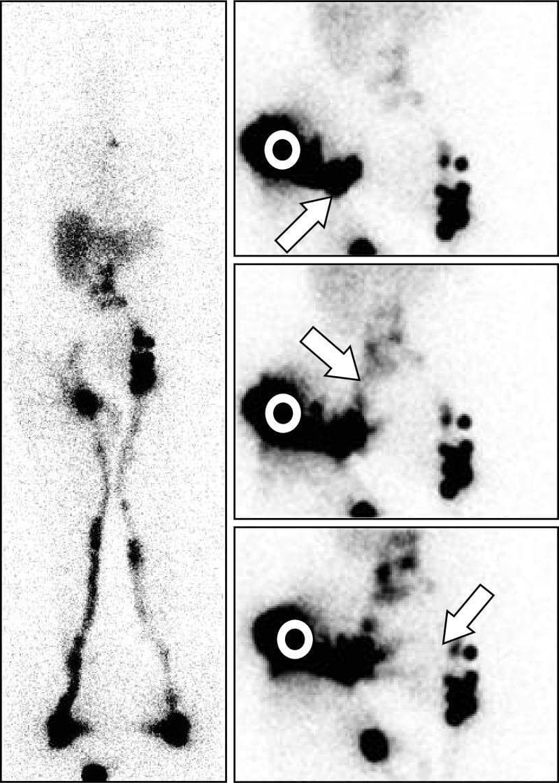 This composite diagnostic image presents 99mTc-human serum albumin nanocolloid lymphoscintigraphy findings in a 69-year-old female with secondary lower limb lymphedema (LLLE) following surgery for inguinal leiomyosarcoma. The left panel shows an anterior whole-body scan (WBS) acquired after one hour of walking. It demonstrates asymmetric lymphatic drainage: the left side displays a normal patent lymphatic vessel (LV) connecting to a complete infradiaphragmatic lymph node (LN) axis, while the right side shows an LV reaching only an inferior inguinal LN with evidence of lymphatic reflux and no visualized common iliac LNs. The right panel consists of three sequential anterior-view static images of the pelvis and abdomen following an additional intradermal injection at the external buttock. These images illustrate collateral lymphatic pathways: an oblique arrow indicates drainage toward the inguinocrural LN, a second arrow highlights drainage toward common iliac LNs, and a third identifies a prepubic pathway crossing to contralateral inguinal LNs. The visualization of these alternative drainage routes is significant for mapping collateral circulation and guiding manual lymphatic drainage therapy in patients with disrupted primary lymphatic pathways.