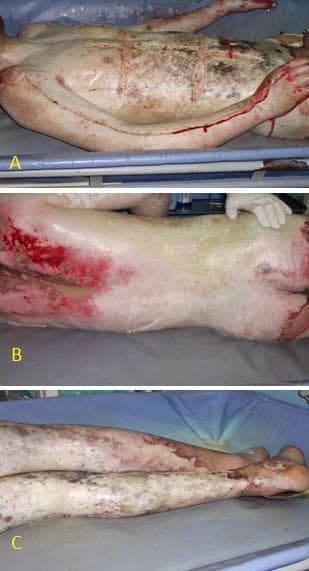 A three-panel clinical photograph (A, B, and C) illustrating a pediatric patient with near-total body surface area (approximately 95% TBSA) thermal injuries. Panel A displays the anterior torso and upper extremity, showing mixed-depth burns characterized by a leathery, charred, and blanched appearance with deep brown and white patches. Several linear escharotomy incisions are visible across the chest, abdomen, and along the medial aspect of the arm to relieve pressure from circumferential burns and prevent compartment syndrome. Panel B shows the posterior aspect of the torso and buttocks, demonstrating extensive full-thickness and deep partial-thickness burns with areas of erythema and skin sloughing. Panel C focuses on the lower extremities, depicting widespread full-thickness burns on both legs with a pale, avascular, and mottled texture, extending to the feet and toes. This series serves as a critical educational example of severe burn management, highlighting the characteristic appearance of eschar in full-thickness injuries and the necessary emergency surgical interventions required in critical care trauma settings.