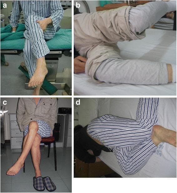 This four-panel clinical photograph illustrates the functional manifestations of bilateral gluteal muscle contracture (GMC) and the results following arthroscopic release. (a) Pre-operative view showing the 'cross-leg sign'; the patient is unable to cross their legs while sitting due to limited hip adduction and flexion. (b) Pre-operative Ober's test demonstrating a positive result, where the upper leg remains abducted and cannot adduct toward the examination table while the patient is in a lateral decubitus position, indicating tight iliotibial bands or gluteal fascia. (c) Post-operative functional assessment three days after arthroscopic release, showing the patient successfully crossing their legs without assistance. (d) Post-operative Ober's test demonstrating a negative result, with the upper leg now able to adduct fully toward the table. The series demonstrates the clinical efficacy of surgical release in restoring hip range of motion, specifically adduction and flexion, which are pathognomonic limitations in GMC.