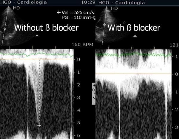This Comparison Chart displays two side-by-side Doppler echocardiography panels illustrating the hemodynamic effects of beta-blocker therapy on intraventricular gradients (IVG). Each panel contains a B-mode ultrasound image at the top (parasternal long-axis view) and a continuous-wave Doppler spectral waveform below. The left panel ('Without beta blocker') shows a high-velocity, late-systolic peaking envelope reaching a peak velocity (Vel) of 526 cm/s and a pressure gradient (PG) of 110 mmHg, characteristic of dynamic left ventricular outflow tract obstruction. The recorded heart rate is 160 BPM. The right panel ('With beta blocker') demonstrates a significant reduction in the Doppler envelope's depth and intensity, reflecting a lower flow velocity and decreased pressure gradient, with a corresponding heart rate reduction to 121 BPM. This comparison illustrates the clinical use of beta-blockers to manage exertional intraventricular gradients and systolic anterior motion (SAM) of the mitral valve by reducing contractility and heart rate. The educational focus is on pharmacological intervention for dynamic cardiac obstruction and the interpretation of Doppler spectral displays in sports cardiology and hemodynamics.