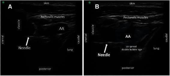 Two-panel diagnostic ultrasound image demonstrating a posterior parasagittal in-plane approach for an infraclavicular brachial plexus block. Panel A shows the baseline anatomy including the skin, pectoralis muscles, and the hypoechoic circular axillary artery (AA). The clavicle is visible cranially as a dense bony structure, and the lung is located in the inferior/caudal field. A hyperechoic block needle is visualized in a horizontal trajectory advancing toward the posterior aspect of the axillary artery. Panel B illustrates the local anesthetic (LA) injection. The needle tip is positioned posterolateral to the axillary artery, where the deposition of anesthetic creates a 'double bubble sign'—characterized by two adjacent hypoechoic fluid collections. This sign confirms appropriate circumferential spread around the brachial plexus cords within the infraclavicular space. The orientation is labeled with cranial, caudal, and posterior markers to guide clinical application in regional anesthesia.