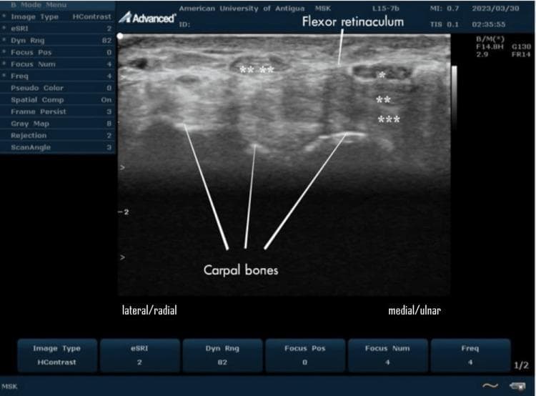This transverse B-mode ultrasound image demonstrates the anatomy of a normal human carpal tunnel at the volar aspect of the wrist. The scan displays the median nerve (marked with a single asterisk *) as a hypoechoic, oval structure located immediately deep to the hyperechoic flexor retinaculum. Relative to the nerve, the superficial (**) and deep (***) flexor tendons appear more hyperechoic. The carpal bones form the deep floor of the tunnel, visualized as hyperechoic curvilinear lines with distal acoustic shadowing. The tendon of the flexor carpi radialis (****) is visible on the lateral/radial aspect, situated outside the primary carpal tunnel compartment. The image serves as a clinical reference for musculoskeletal (MSK) sonography, illustrating the distinctive honeycomb or cyst-like texture of the nerve in cross-section compared to the fibrillar pattern of adjacent tendons. This orientation is essential for diagnosing peripheral nerve entrapment syndromes, such as carpal tunnel syndrome, where median nerve morphology and echogenicity are primary diagnostic criteria.