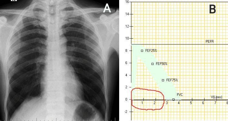 This composite medical image presents diagnostic findings for airway evaluation, consisting of a chest radiograph and a pulmonary function test graph. Image A is a posterior-anterior (PA) chest radiograph demonstrating hyperinflated lung fields characterized by increased radiolucency and flattened diaphragms, while the mediastinal contour and heart size appear within normal limits. Image B is a flow-volume loop from a spirometry assessment. The graph shows a characteristic flattening of both the expiratory (upper) and inspiratory (lower) limbs of the loop, resulting in a rectangular appearance rather than the typical triangular peak. This 'box-like' morphology is a classic physiological sign of a fixed large airway obstruction, such as subglottic stenosis or a tracheal mass. Key data points on the graph include Forced Expiratory Flow (FEF) at 25%, 50%, and 75% of vital capacity, and Peak Expiratory Flow Rate (PEFR). The clinical significance lies in the correlation between radiographic signs of air trapping and the physiological evidence of impaired airflow in both phases of respiration, facilitating the diagnosis of upper airway pathology.