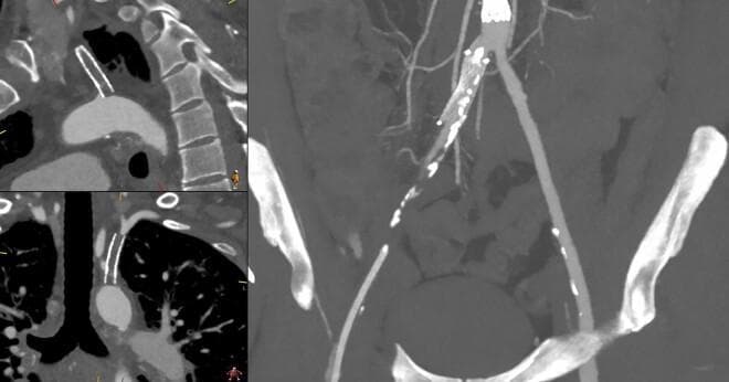 This diagnostic image consists of multi-planar Computed Tomography Angiography (CTA) views illustrating peripheral artery disease (PAD) in the upper and lower extremities. The left panels provide sagittal and coronal reconstructions of the aortic arch and proximal great vessels, highlighting an occluded or severely stenosed left subclavian artery characterized by a truncated contrast column and endovascular stent markers. The larger right panel shows a Maximum Intensity Projection (MIP) of the abdominal aorta and iliofemoral arteries. This view demonstrates significant atherosclerotic burden, evidenced by extensive, irregular mural calcifications (bright white foci) and luminal narrowing along the common and superficial femoral arteries. There is a visible discrepancy in contrast opacification between the patent proximal vessels and the diseased, calcified distal segments. This visual aid is intended for medical education regarding the diagnostic evaluation of systemic atherosclerosis, vascular imaging interpretation, and the clinical presentation of chronic limb-threatening ischemia.