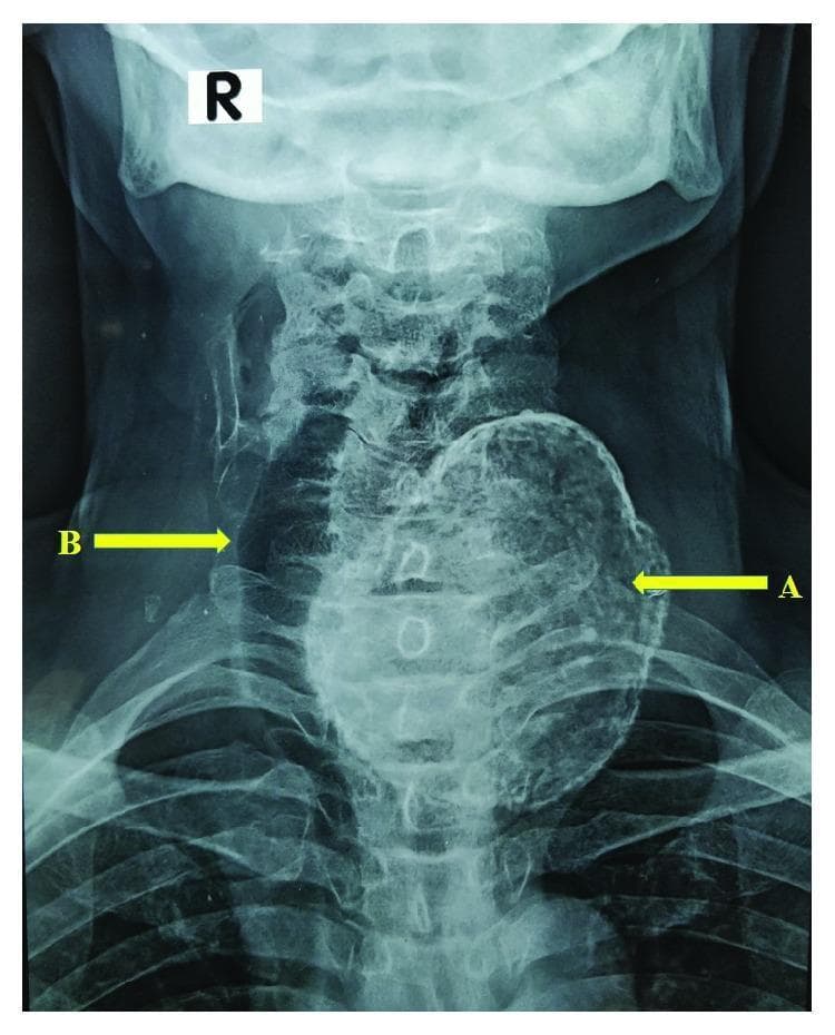 This anteroposterior (AP) neck X-ray demonstrates a diagnostic image of severe goitre with extensive dystrophic calcification. The primary finding is a large, dense, radio-opaque mass in the left cervical region, indicated by arrow A, which corresponds to a heavily calcified left thyroid lobe. The mass exhibits a characteristic 'eggshell' or coarse calcification pattern along its periphery. Significant mass effect is evident as the trachea, marked by arrow B, is markedly displaced and deviated toward the right side of the midline. The cervical vertebrae and upper thoracic ribs are visible in the background, providing anatomical context for the degree of tracheal shifting. This image illustrates the clinical consequences of long-standing multinodular goitre, specifically airway compression and deviation caused by calcified thyroid enlargement. It is an educational example for radiology and endocrinology students regarding the evaluation of cervical masses and their impact on adjacent midline structures.