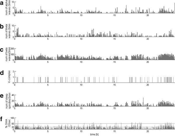 This diagnostic graphic illustrates a 24-hour continuous EEG monitoring profile of a patient, likely in a state of disordered consciousness. The data is presented in six stacked subplots (a-f) representing different EEG components over time (in hours). Subplots (a), (b), (c), and (e) quantify the number of alpha, theta, and beta waves, and sleep spindles per 3-minute epoch, respectively. Subplot (d) indicates discrete markers for K-complex occurrences. Subplot (f) displays the percentage of slow-wave activity (SWA) per 20-second epoch, with horizontal thresholds at 20% and 50% corresponding to classical criteria for sleep stages 3 and 4. The profile demonstrates a lack of normal circadian rhythm, characterized by the absence of nocturnal concentration of sleep spindles and slow waves. There is no clear inverse correlation between sleep spindles and SWA, suggesting an atypical sleep-wake architecture. This method of continuous parametric assessment provides educational value in distinguishing between vegetative states (UWS) and minimally conscious states (MCS) through objective temporal analysis of electroencephalographic features.