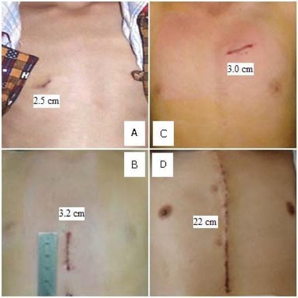 This clinical photograph set provides a side-by-side comparison of surgical incisions on the chest for treating congenital heart defects (CHD). The image illustrates the difference between Off-Pump Occlusion via Transthoracic Minimally Invasive Surgery (OPOTTMIS) and Traditional Open Surgery (TOS). Panels A, B, and C demonstrate the minimally invasive approach used for Atrial Septal Defect (ASD), Ventricular Septal Defect (VSD), and Patent Ductus Arteriosus (PDA) respectively, featuring small, localized incisions ranging from 2.5 cm to 3.2 cm in length. These are located in various thoracic regions (lateral and parasternal). In contrast, Panel D shows a Traditional Open Surgery incision, which is a significant 22 cm midline median sternotomy scar extending vertically down the center of the chest. The visual highlights the pedagogical concept of 'minimally invasive' by contrasting the cosmetic and anatomical impact of contemporary occlusion techniques versus traditional longitudinal sternotomy for pediatric cardiac procedures.