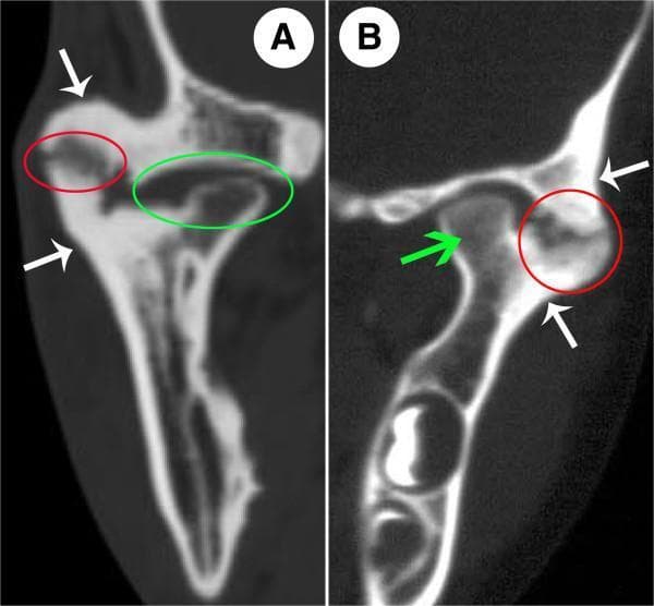 Diagnostic computerized tomography (CT) images of the temporomandibular joint (TMJ) demonstrating features of bony ankylosis. Panel A (coronal view) and Panel B (axial view) illustrate a characteristically heterogeneous fusion pattern. In both views, red circles highlight the lateral bony fusion area between the mandibular condyle and the temporal bone, which contains a distinct radiolucent zone without calcified dots. In Panel B, significant osteosclerosis is visible within this fusion site. Medially, a green circle in Panel A identifies an atrophic condylar head with a persisting but rudimentary joint space, representing a non-fused segment. White arrows in both images point to prominent periarticular excessive bone formation and thickening. A green arrow in Panel B indicates a non-bony fusion area where the bone mineral density and marrow cavity morphology remain relatively normal. These images demonstrate the diagnostic criteria for TMJ ankylosis, including ectopic ossification, joint space obliteration, and structural remodeling of the condyle-fossa complex.