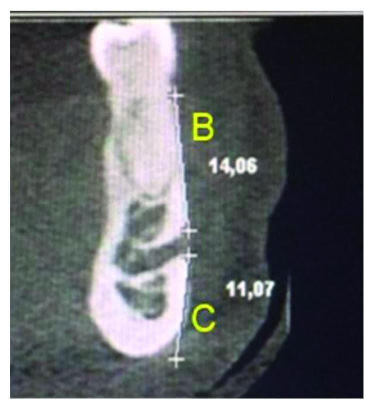 This diagnostic image is a coronal cross-section of a human mandible obtained via Computed Tomography (CT), specifically used for dentomaxillofacial morphometric analysis. The image highlights the vertical position of the mental foramen (MF) relative to local anatomical landmarks. Two linear measurements are annotated: 'Distance B' (labeled 'B') measures 14.06 mm from the superior cortical border of the mental foramen to the alveolar crest; 'Distance C' (labeled 'C') measures 11.07 mm from the superior cortical border of the mental foramen to the inferior base of the mandible. The mental foramen is visible as a radiolucent opening on the vestibular (buccal) aspect of the cortical bone. This type of imaging is clinically significant for preoperative planning in oral surgery, dental implantology, and endodontics to avoid neurovascular injury to the mental nerve. The image clearly demonstrates the cross-sectional anatomy of the mandibular body, including the dense outer cortical bone and internal trabecular patterns.