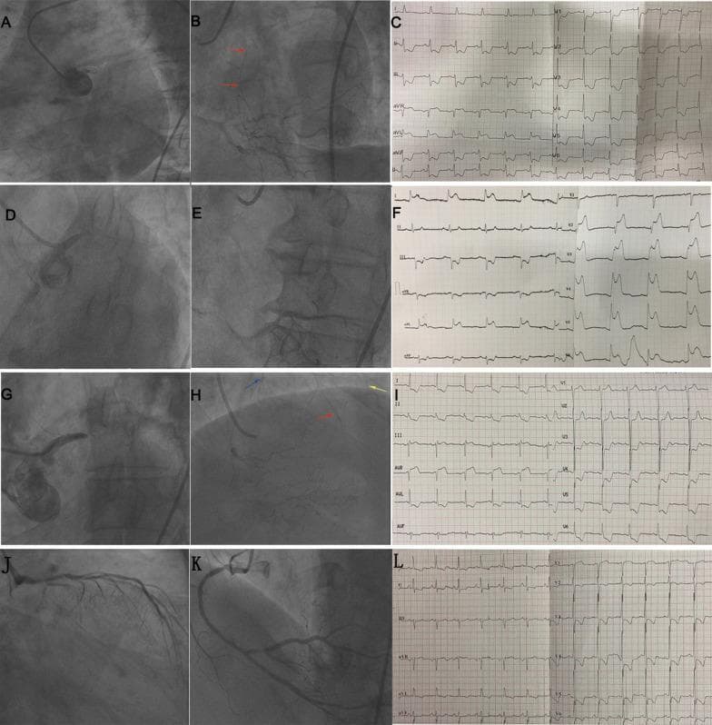 This composite clinical figure presents a comparative study of four patients with unprotected left main (ULM) coronary artery occlusion, utilizing coronary angiograms and 12-lead electrocardiograms (ECGs). The visual content is organized into four rows (A-C, D-F, G-I, and J-L), each illustrating a specific clinical scenario. Rows A-C and G-I demonstrate cases with retrograde collateral circulation filling the left anterior descending (LAD) and left circumflex (LCX) arteries (indicated by colored arrows in angiograms B and H), correlating with ST-segment elevation (STE) in lead aVR and sometimes aVL (ECGs C and I). In contrast, rows D-F and J-L depict cases with absent collateral circulation. In the absence of collaterals, total ULM occlusion (E) presents as a STEMI pattern with extensive STE in precordial (V1-V6) and lateral leads (ECG F). Subtotal ULM obstruction without collaterals (K) displays STE specifically in leads aVR and V1 (ECG L). This diagnostic comparison highlights the critical relationship between collateral flow presence, coronary anatomy, and specific ST-segment elevation patterns in the setting of high-risk coronary artery disease.