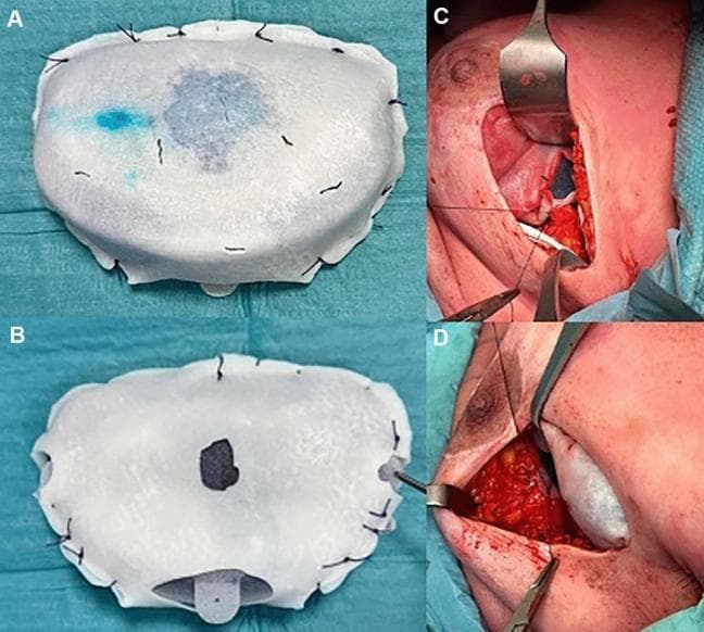 This composite of clinical photographs illustrates a pre-pectoral breast reconstruction procedure using a tissue expander and acellular dermal matrix (ADM). Panels A and B show a textured tissue expander fully encapsulated in a white, opaque, porcine-derived ADM. The matrix is secured around the expander's periphery with a series of interrupted black sutures. Panel A demonstrates a light blue discoloration on the ADM surface, resulting from the internal saline and methylene blue solution. Panels C and D show the intraoperative surgical site where the ADM-wrapped expander is placed into the pre-pectoral pocket. Surgical retractors expose the operative field, revealing the implant secured to the pectoralis muscle fascia. The ADM is fixed at multiple anatomical points (superior, medial, and inferior) using resorbable sutures to ensure stability and prevent rotation. This technique highlights the 'total wrap' method for single-stage or two-stage pre-pectoral breast reconstruction, aimed at providing soft tissue support and improving aesthetic outcomes.