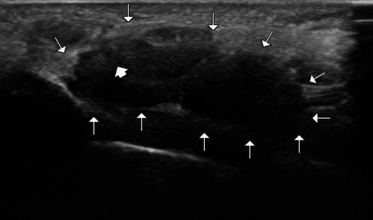 This diagnostic image is a transverse ultrasound of the wrist, focusing on the carpal tunnel. The image demonstrates the cross-sectional anatomy of the carpal tunnel, with its boundaries delineated by multiple white arrowheads. These arrowheads highlight the arch-shaped space formed by the deep carpal bones and the superficial, echogenic flexor retinaculum. Within the tunnel, a thick white arrow points to the median nerve, which presents as a relatively hypoechoic, oval structure with a fascicular internal texture. Surrounding the nerve are the flexor tendons, visible as more heterogeneous and slightly more echogenic structures within the tunnel space. This imaging modality and view are used in clinical practice for diagnosing carpal tunnel syndrome, assessing median nerve cross-sectional area, and identifying space-occupying lesions. The focus is on neuromuscular and musculoskeletal diagnostic features relevant to radiology and physical medicine.